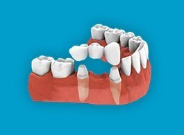 home1 DENTAL CROWN & BRIDGE