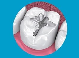 home6 DENTAL FILLINGS / RESTORATION