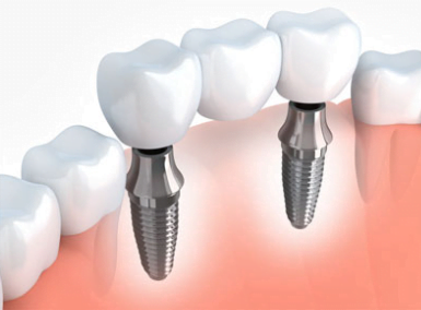 Dental Implants (2) dental implants