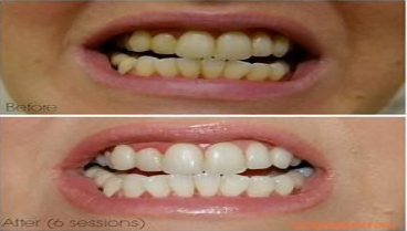 teeth whitening result teeth whitening result